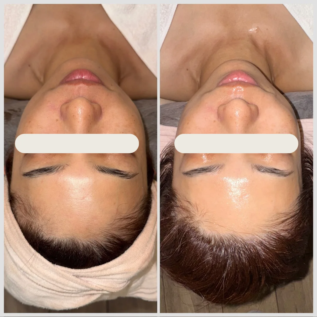 Dactor Peel施術のビフォーアフター、1回、肌の透明感と艶感の改善