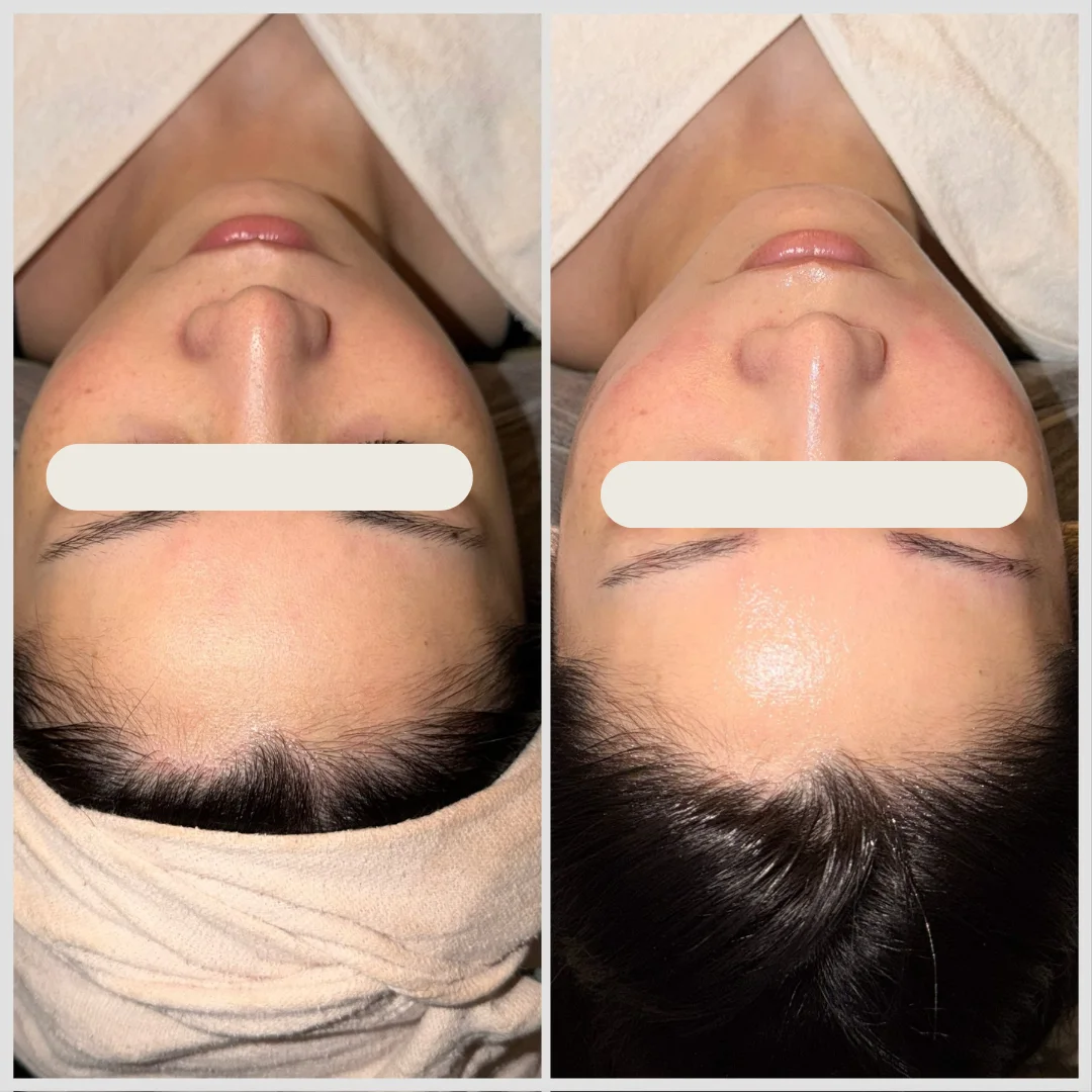 Dactor Peel施術のビフォーアフター、1回、トーンとキメ感、艶感の改善